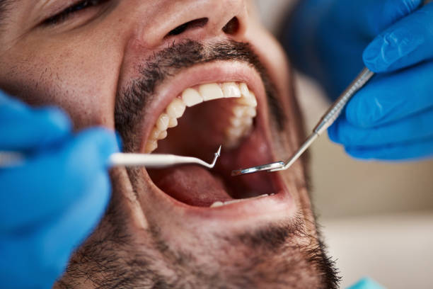 Best Emergency Wisdom Teeth Removal in Brilliant, OH